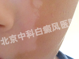 пư